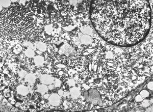 F,39y. | metastatic alveolar sarcoma of soft parts